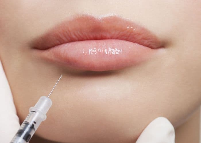 Lip augmentation filler treatment for fuller plump lips